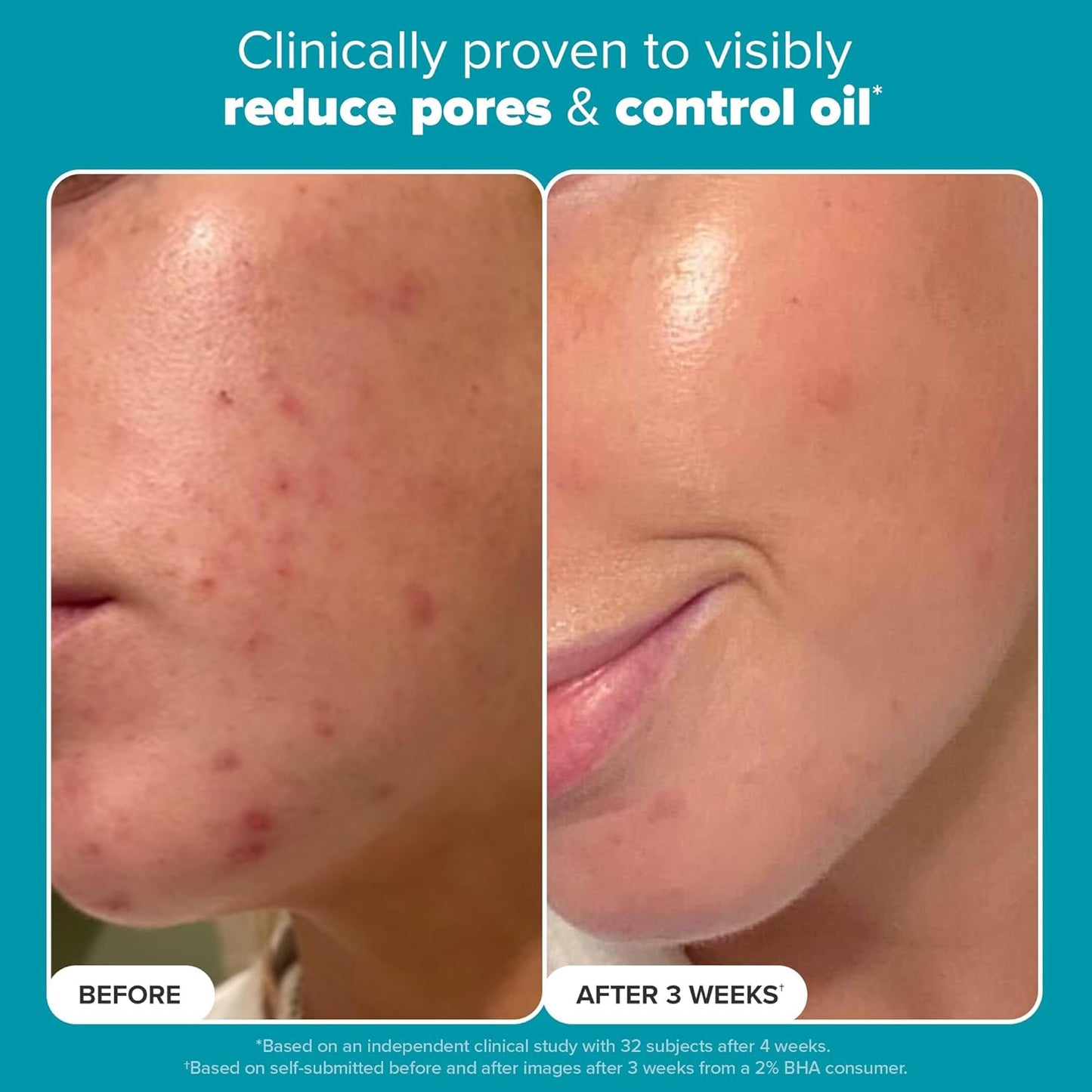 Skin Perfecting BHA Exfoliant™