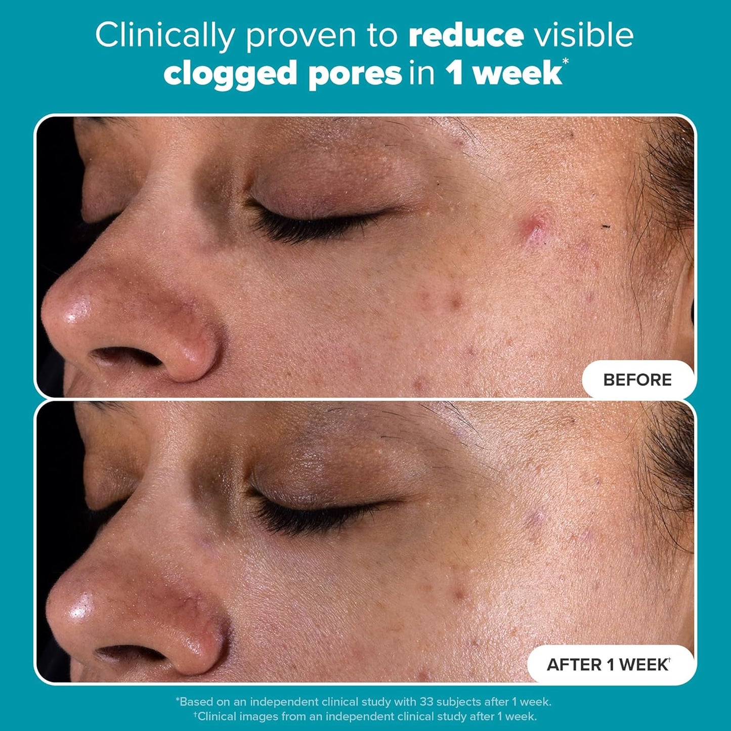 Skin Perfecting BHA Exfoliant™
