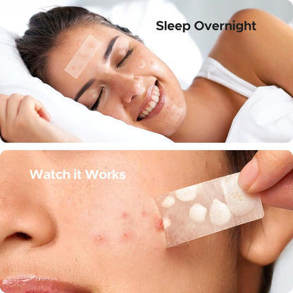 Pimple Patch Pro™ – Clear Skin Revolution