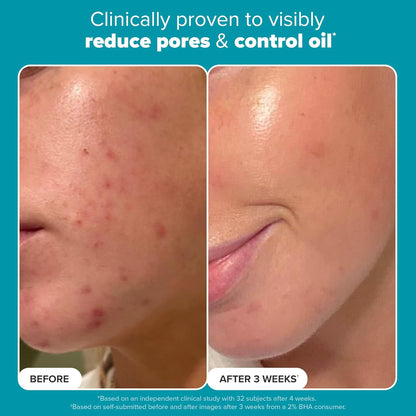 Skin Perfecting BHA Exfoliant™